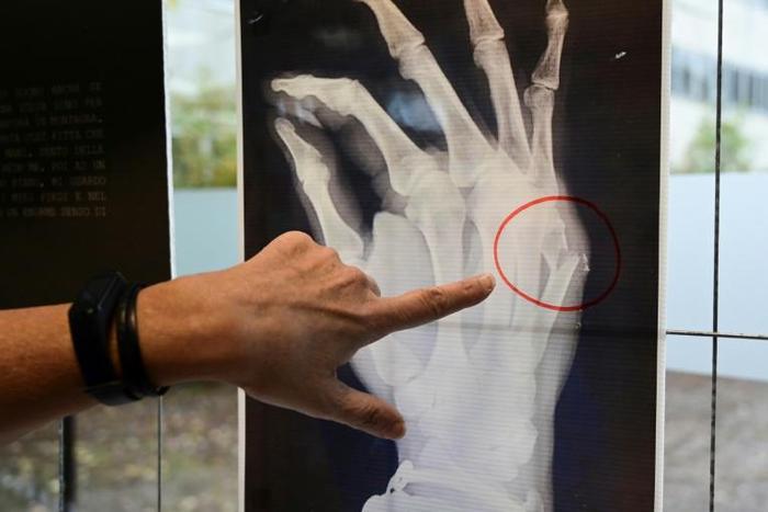 A Milan hospital is displaying X-rays from victims of domestic violence who have passed through the doors of the facility seeking help