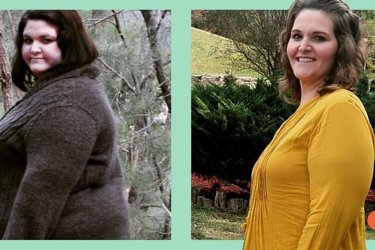 'I've Kept Off 183 Lbs. Since Bariatric Surgery'