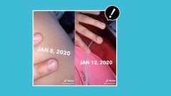 Teen Warns Against Nail Biting After Infection