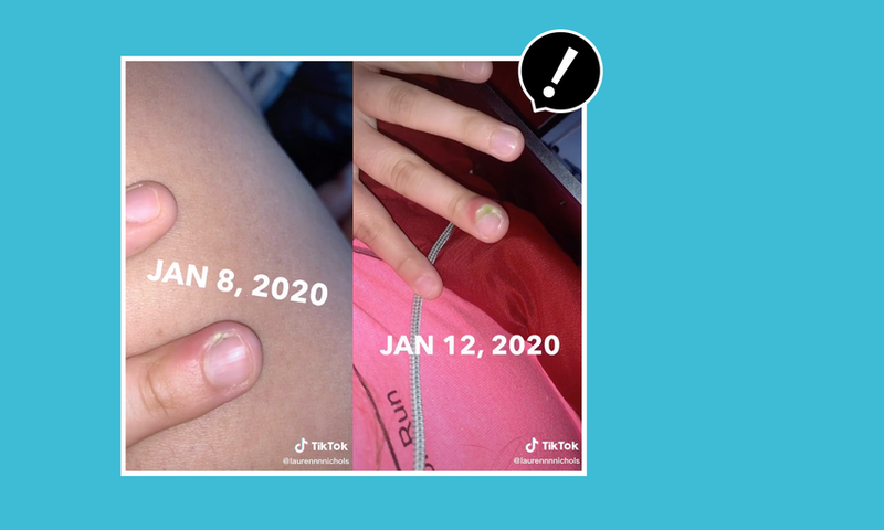 Teen Warns Against Nail Biting After Infection
