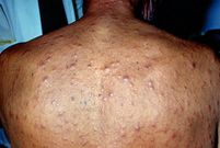 Syphilis patient