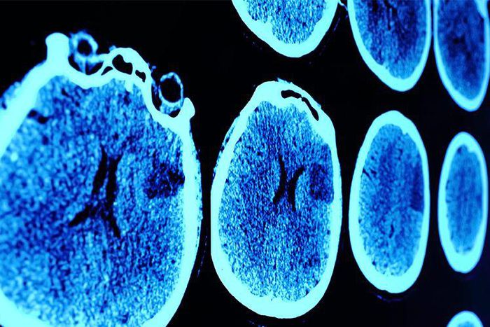 7 Brain Cancer Symptoms Every Woman Should Know