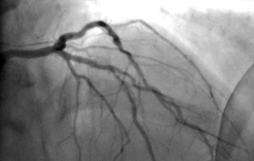 Surgery for Blocked Arteries Is Often Unwarranted, Researchers Find