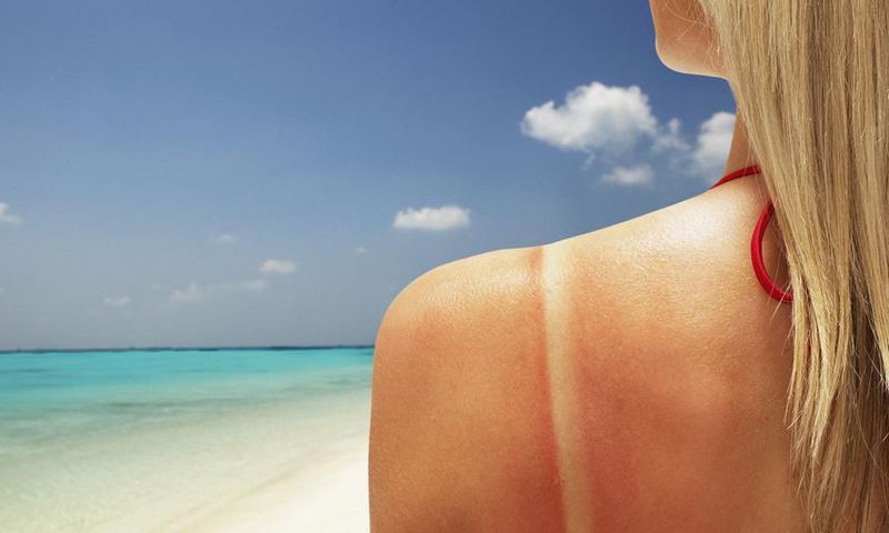 Here's How To Stop An Itchy Sunburn Fast
