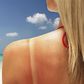 Here's How To Stop An Itchy Sunburn Fast