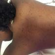 What your acne means (Elite Daily)