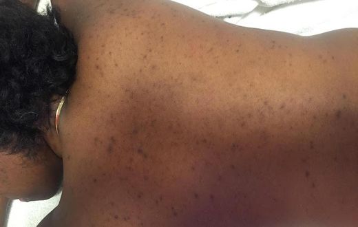 What your acne means (Elite Daily)