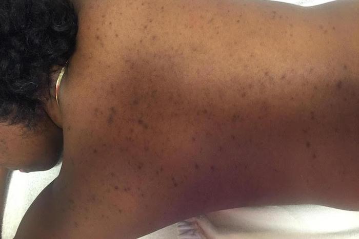 What your acne means (Elite Daily)