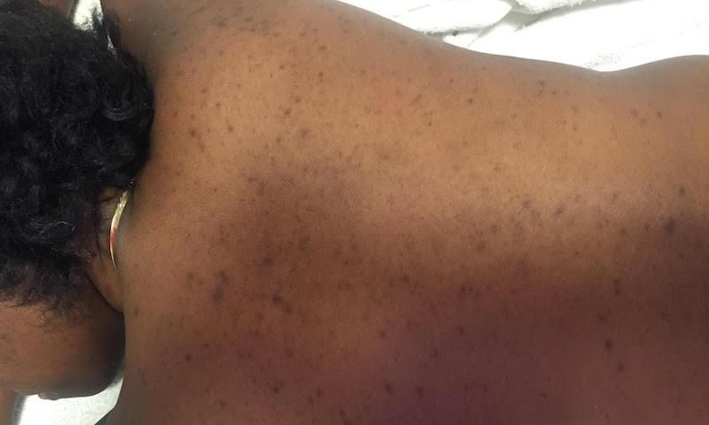 What your acne means (Elite Daily)