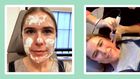 "Microneedling made my skin softer than ever."