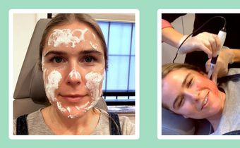 "Microneedling made my skin softer than ever."