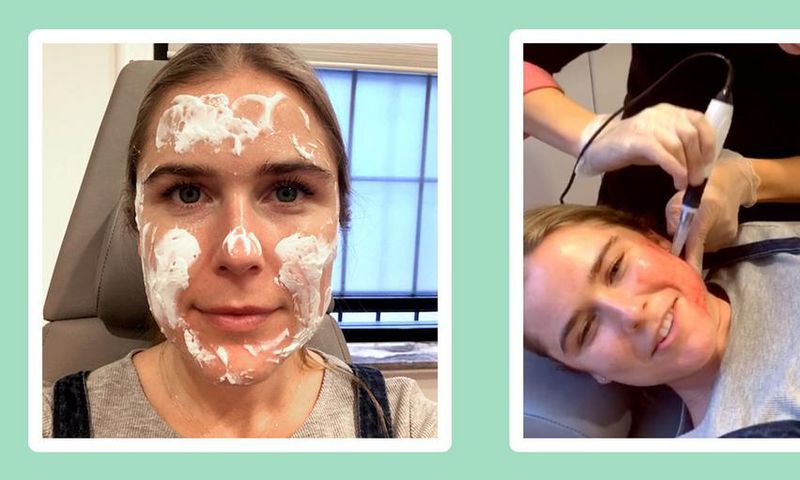 "Microneedling made my skin softer than ever."