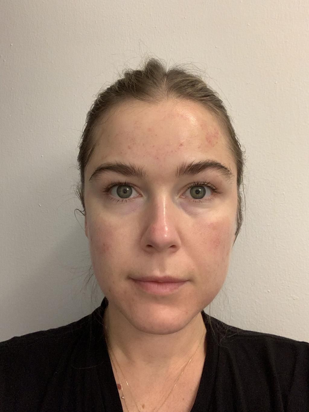 The morning after microneedling.