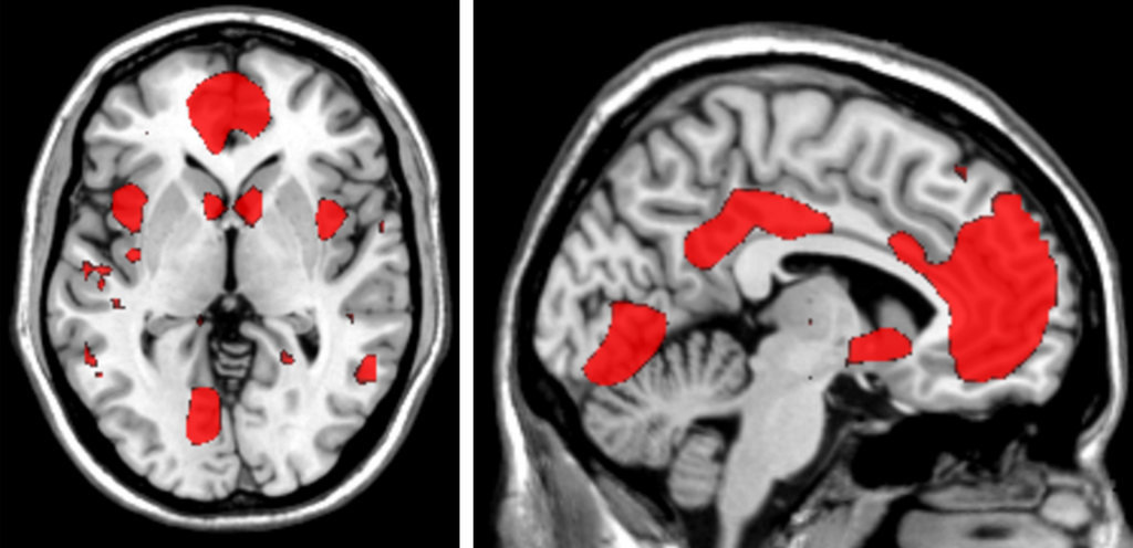 <strong>MEMORY IS REALLY</strong> complicated: This fMRI data from the Stanford Memory Lab shows the numerous areas of the brain (from two different angles!) that are recruited during successful memory retrieval.