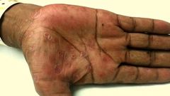 hand rash (Academic Life in Emergency Medicine)