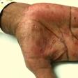 hand rash (Academic Life in Emergency Medicine)