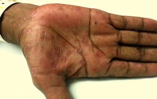 hand rash (Academic Life in Emergency Medicine)