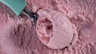 Watch Dr. P Scoop Out A Creamy Cyst