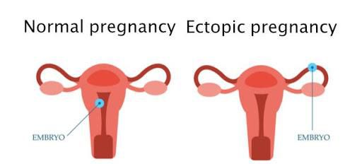 Bleeding in early pregnancy:  Common causes & symptoms