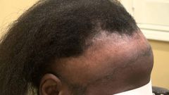 Hair loss (wwwlearnbemobile)