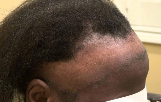 Hair loss (wwwlearnbemobile)