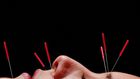 Can Acupuncture Really Help You Lose Weight?