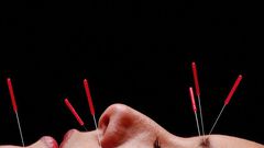 Can Acupuncture Really Help You Lose Weight?