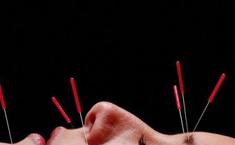 Can Acupuncture Really Help You Lose Weight?