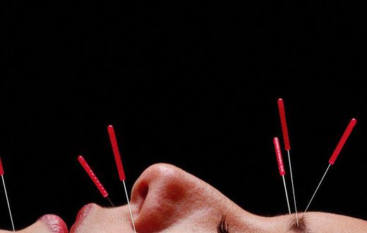 Can Acupuncture Really Help You Lose Weight?