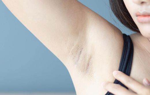 Watch Dr. P Squeeze An Armpit Steatocystoma