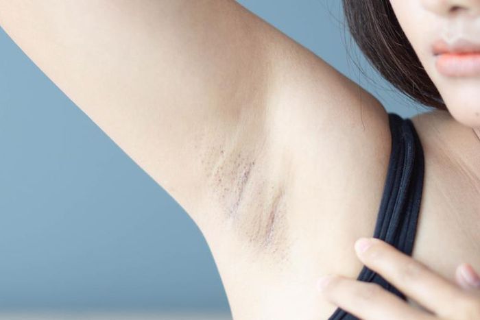 Watch Dr. P Squeeze An Armpit Steatocystoma