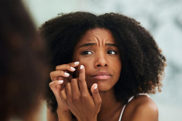 5 reasons why your acne never seem to disappear