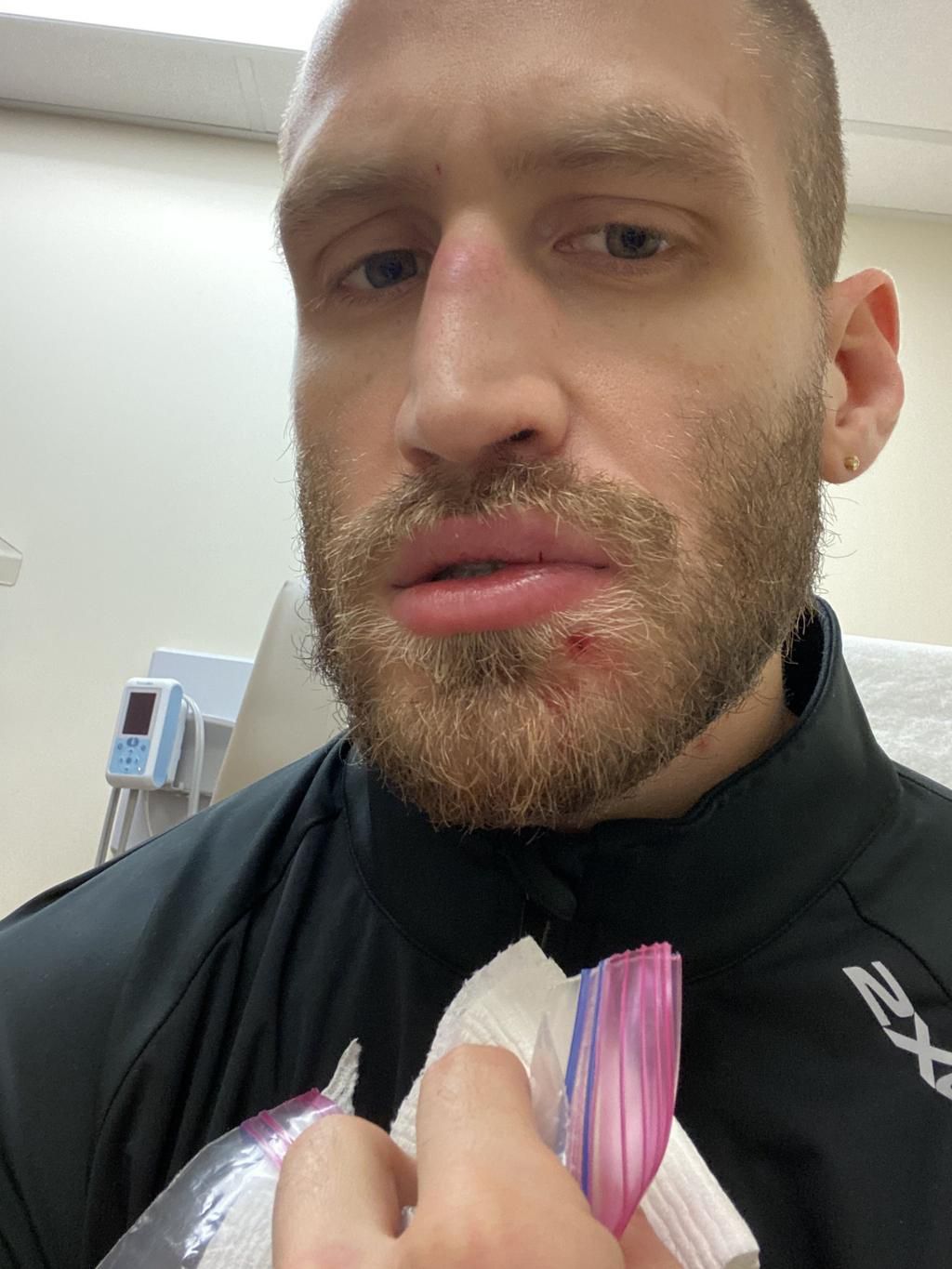 I wound up in urgent care with a hole in my face, a busted lip, and a shiner on my nose. Not a great situation.