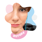zitsticka before and after