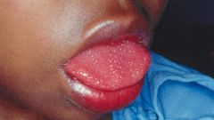 Children affected by strange disease linked to Covid-19