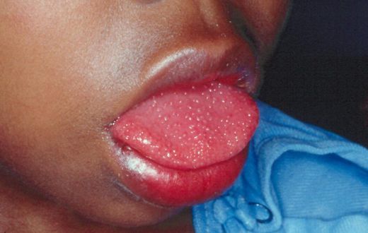 Children affected by strange disease linked to Covid-19
