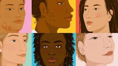 How to Cover Up Every Type of Acne