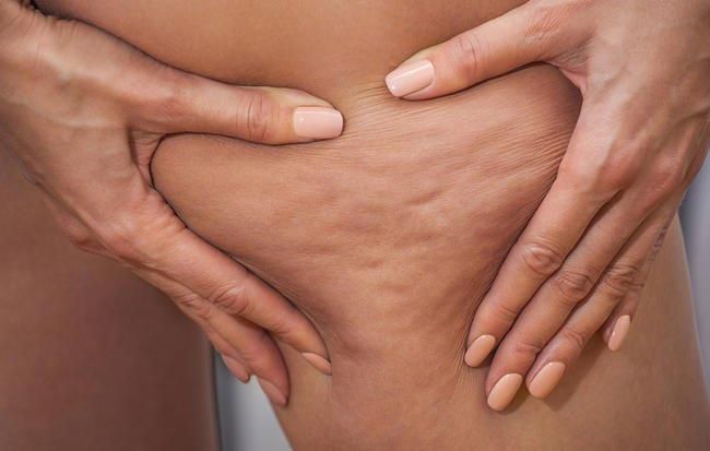 cellulite