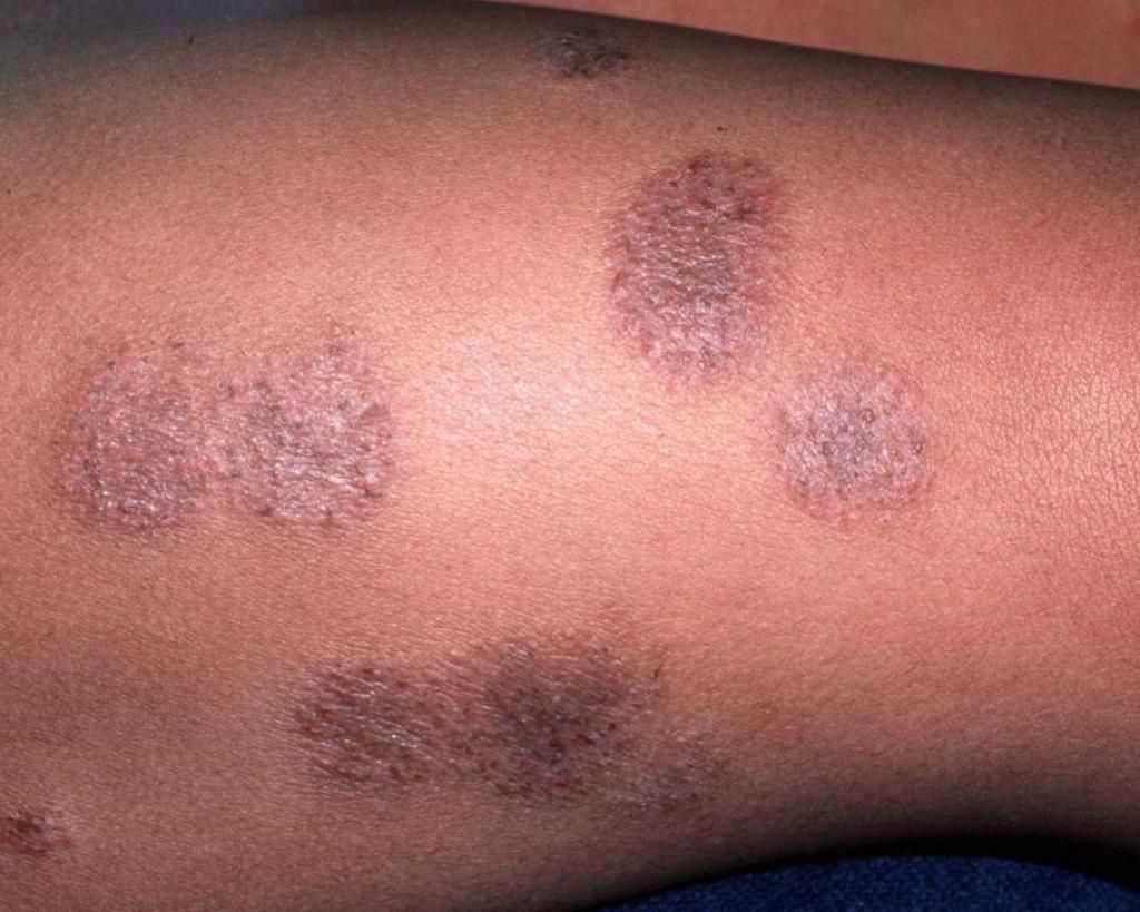 Eczema can affect any part of the body