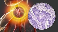 Oesophageal cancer, computer illustration and light micrograph. Cancers such as this may lead to difficulty in swallowing. Oesophageal cancer is usually not detected until it has spread to other parts of the body.
