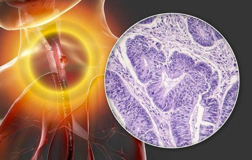 Oesophageal cancer, computer illustration and light micrograph. Cancers such as this may lead to difficulty in swallowing. Oesophageal cancer is usually not detected until it has spread to other parts of the body.