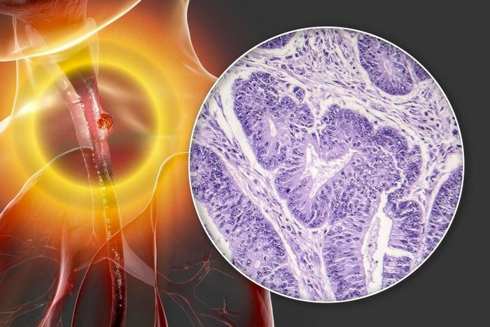Oesophageal cancer, computer illustration and light micrograph. Cancers such as this may lead to difficulty in swallowing. Oesophageal cancer is usually not detected until it has spread to other parts of the body.