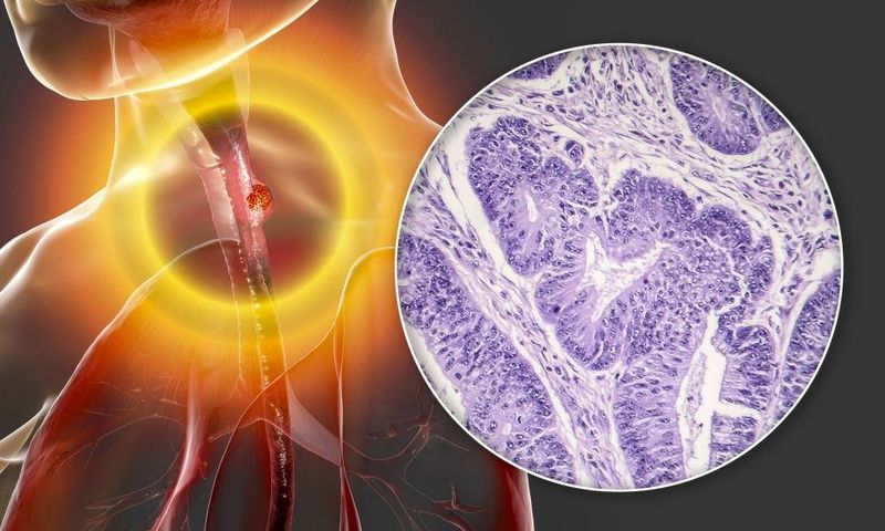 Oesophageal cancer, computer illustration and light micrograph. Cancers such as this may lead to difficulty in swallowing. Oesophageal cancer is usually not detected until it has spread to other parts of the body.