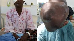 Moi Teaching & Referral Hospital removes cystic growth that covered Beatrice Makokha’s face