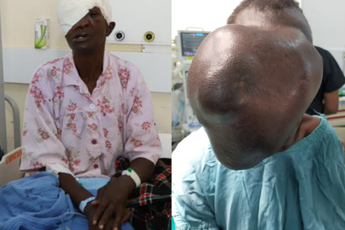 Moi Teaching & Referral Hospital removes cystic growth that covered Beatrice Makokha’s face