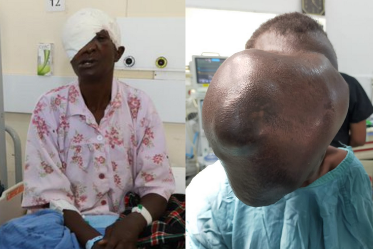 Moi Teaching & Referral Hospital removes cystic growth that covered Beatrice Makokha’s face