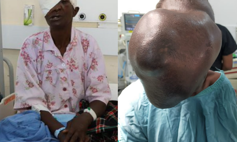 Moi Teaching & Referral Hospital removes cystic growth that covered Beatrice Makokha’s face