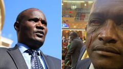 National Assembly Minority Leader John Mbadi and an injured Sigowet-Soin MP Benard Koros