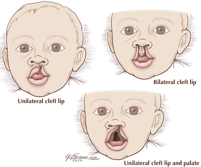 cleft lip palate