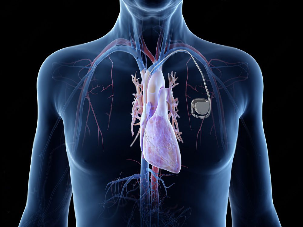 Pacemaker
